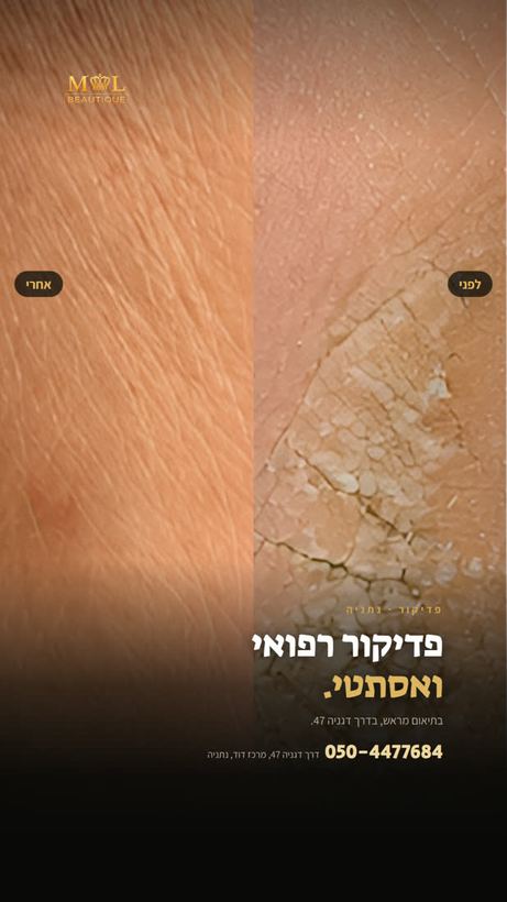 מודעת סטורי למכון יופי, פדיקור רפואי, לפני ואחרי